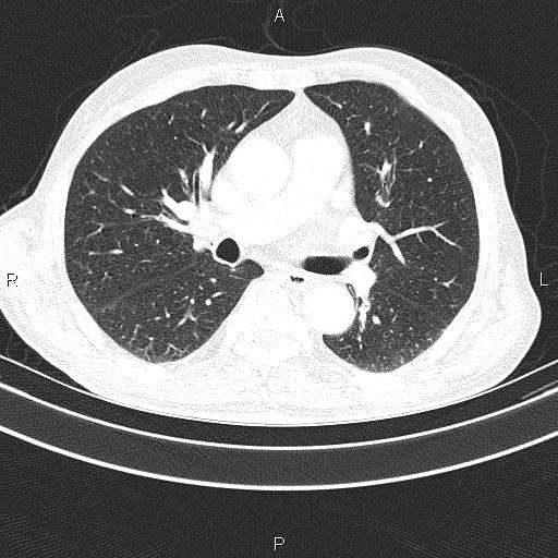 Ampullary adenocarcinoma (Radiopaedia 86093-102033 Axial lung window 31).jpg