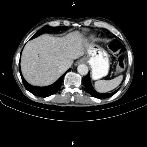 Ampullary adenocarcinoma (Radiopaedia 86093-102033 B 49).jpg