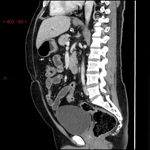 Ampullary carcinoma (Radiopaedia 56396-63056 D 59).jpg