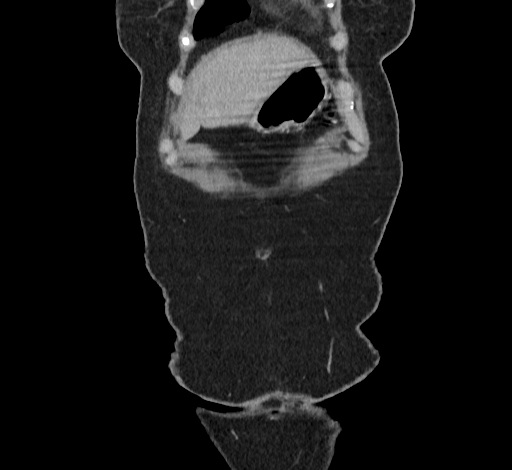 Ampullary tumor (Radiopaedia 60333-67998 B 3).jpg