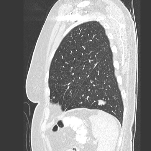 Amyloidosis - bronchial and diffuse nodular pulmonary involvement (Radiopaedia 60156-67745 Sagittal lung window 76).jpg