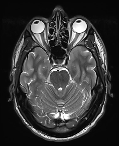 File:Amyotrophic lateral sclerosis (Radiopaedia 87352-103658 Axial T2 8).jpg