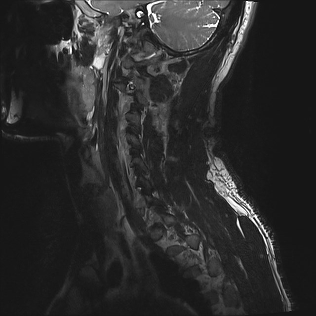 Amyotrophic lateral sclerosis (Radiopaedia 87352-103658 I 57).jpg