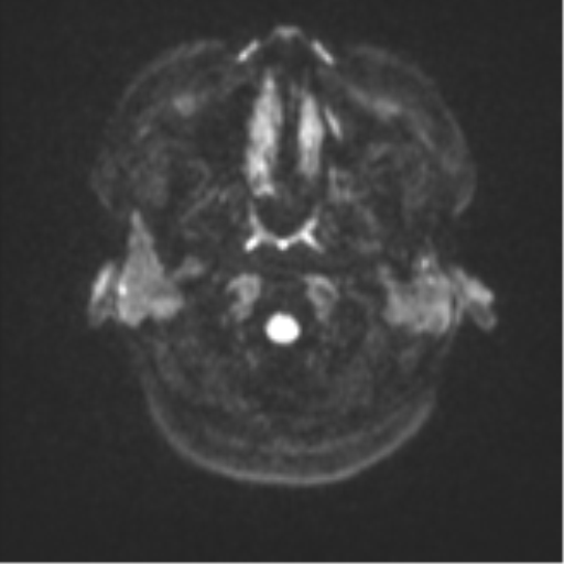 Anaplastic astroblastoma (Radiopaedia 55666-62194 Axial DWI 30).png