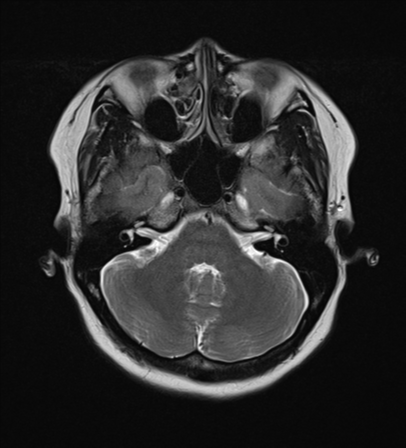File:Anaplastic astroblastoma (Radiopaedia 55666-62194 Axial T2 7).png