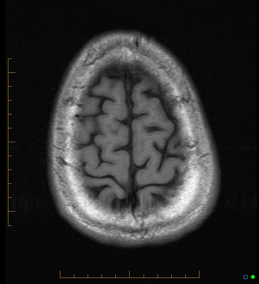 File:Anaplastic astrocytoma (WHO grade III) of the septum pellucidum (Radiopaedia 39365-41633 Axial T1 20).jpg