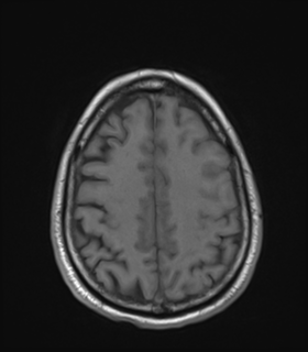 Anaplastic astrocytoma IDH wild-type (Radiopaedia 49984-55273 Axial T1 44).png