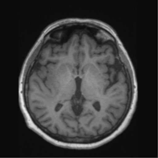 Anaplastic astrocytoma IDH wild-type (pseudoprogression) (Radiopaedia 42209-45276 Axial T1 79).png