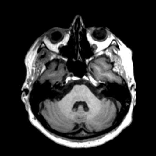 Anaplastic astrocytoma IDH wild-type (pseudoprogression) (Radiopaedia 42209-45277 Axial T1 33).png