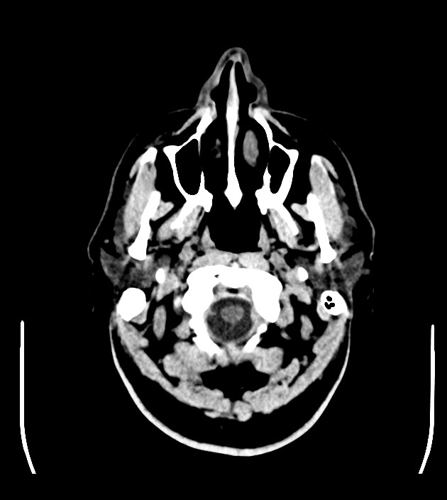 Anaplastic oligodendroglioma (Radiopaedia 79571-92753 Axial non-contrast 6).jpg