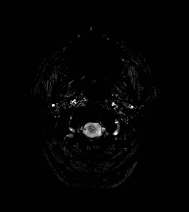 Anaplastic oligodendroglioma (Radiopaedia 79571-92754 F 1).jpg