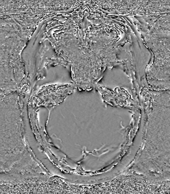 Anaplastic oligodendroglioma (Radiopaedia 83500-98599 Axial SWI - phase 22).png