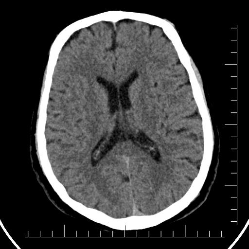 File:Aneurysm of posterior communicating artery (Radiopaedia 20188-20162 Axial non-contrast 28).jpg