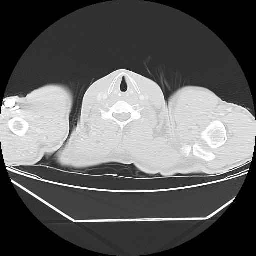 Aneurysmal bone cyst - rib (Radiopaedia 82167-96220 Axial lung window 2).jpg
