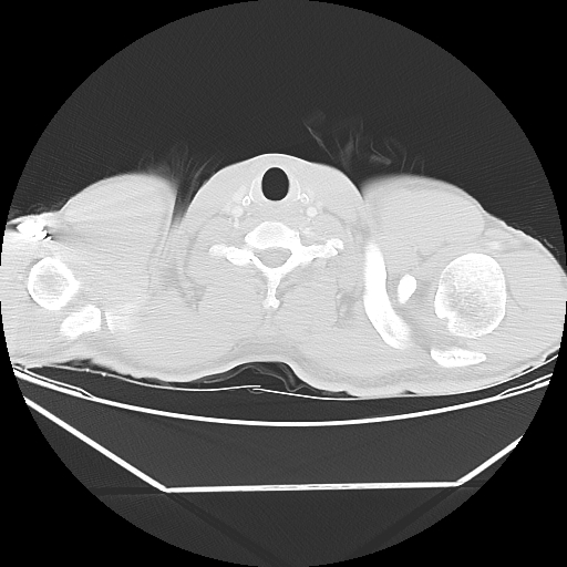 Aneurysmal bone cyst - rib (Radiopaedia 82167-96220 Axial lung window 5).jpg