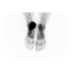 File:Aneurysmal bone cyst of the calcaneus (Radiopaedia 60669-68419 POST. 1).jpg