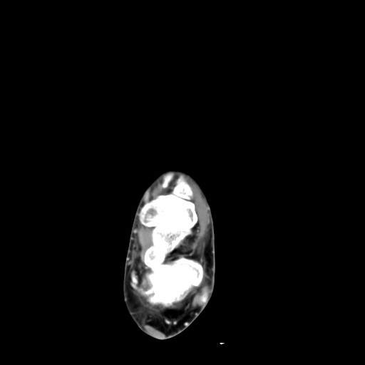 File:Aneurysmal bone cyst of the calcaneus (Radiopaedia 60669-68421 A 23).jpg