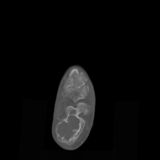 File:Aneurysmal bone cyst of the calcaneus (Radiopaedia 60669-68421 Axial bone window 7).jpg