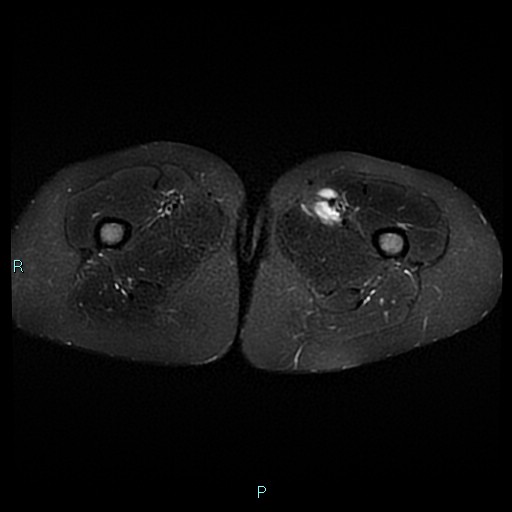 Angioleiomyoma (Radiopaedia 85442-101078 Axial STIR 32).jpg