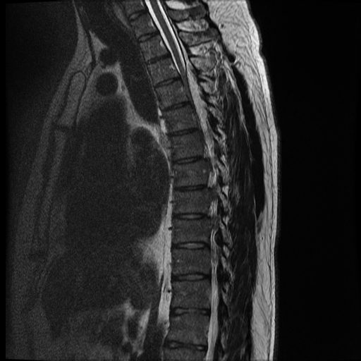 File:Angiolipoma - thoracic spine (Radiopaedia 28242-28479 Sagittal T2 6).jpg