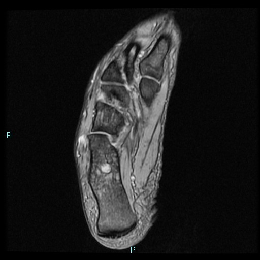 Ankle ganglion cyst (Radiopaedia 62809-71162 Axial Gradient Echo 18).jpg