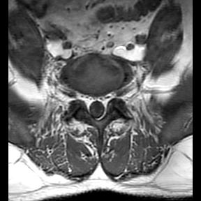 File:Ankylosing spondylitis with zygapophyseal arthritis (Radiopaedia 38433-40516 Axial T1 3).jpg