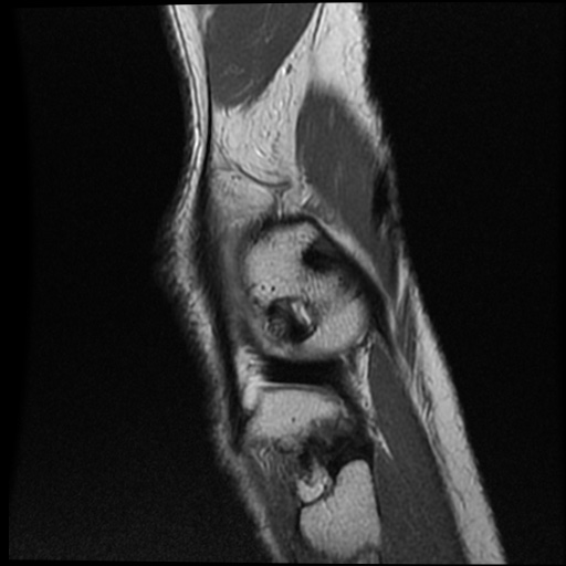 File:Anomalous insertion of the medial meniscus (Radiopaedia 77559-89721 Sagittal PD 10).jpg