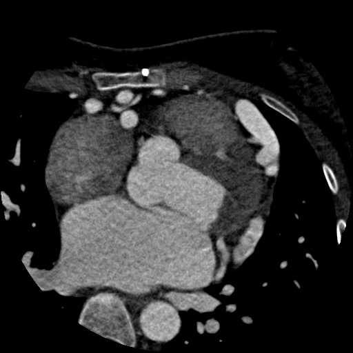 Anomalous left coronary artery from the pulmonary artery (ALCAPA) (Radiopaedia 40884-43586 A 31).jpg