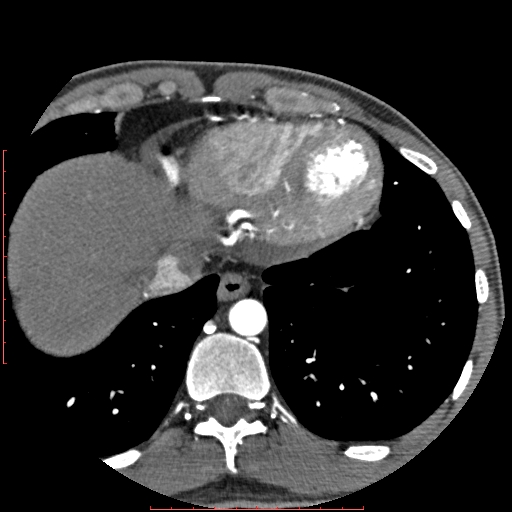 Anomalous left coronary artery from the pulmonary artery (ALCAPA) (Radiopaedia 70148-80181 A 338).jpg