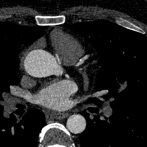 File:Anomalous origin of the left coronary artery with malignant course (Radiopaedia 77842-90126 C 30).jpeg