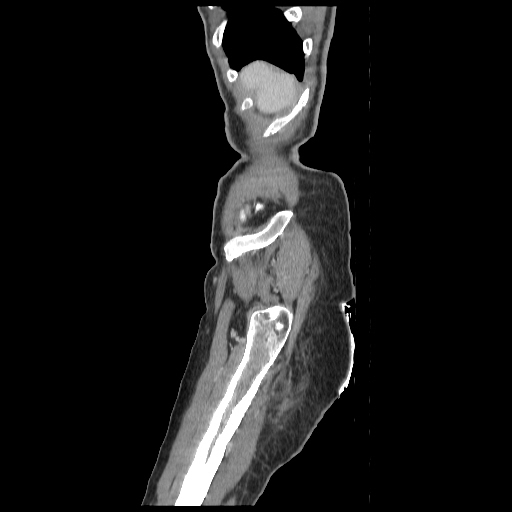 Anorectal carcinoma (Radiopaedia 44413-48064 C 1).jpg
