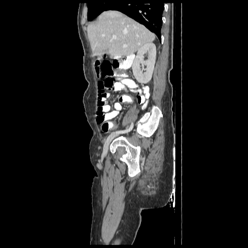 Anorectal carcinoma (Radiopaedia 44413-48064 C 27).jpg