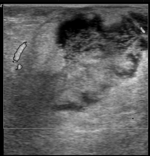 File:Anterior abdominal wall abscess (Radiopaedia 17732-17480 G 1).jpg