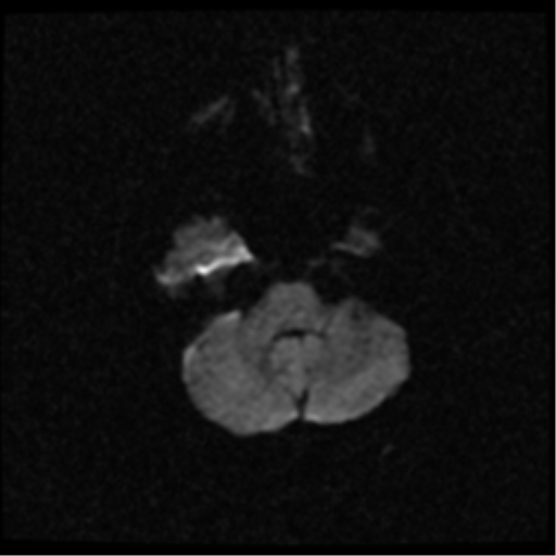 File:Anterior cerebral artery territory infarct (Radiopaedia 39327-41584 Axial DWI 5).png