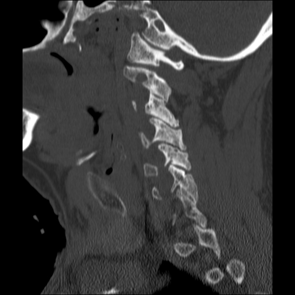 Anterior cervical postdiscectomy arthrodesis (Radiopaedia 32678-33646 Sagittal bone window 20).jpg