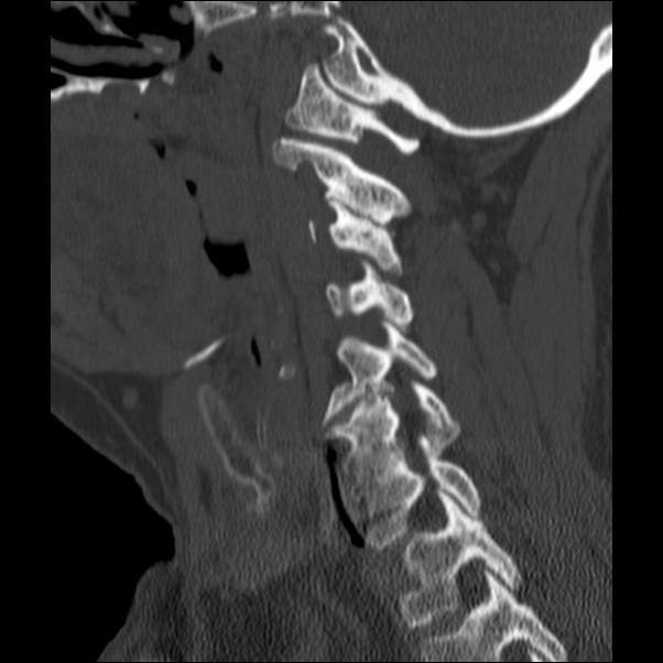 Anterior cervical postdiscectomy arthrodesis (Radiopaedia 32678-33646 Sagittal bone window 51).jpg