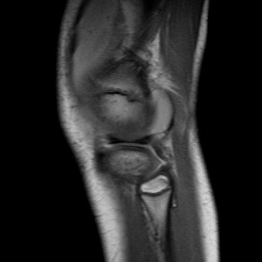 File:Anterior cruciate ligament avulsion fracture (Radiopaedia 24710-24974 Sagittal T1 11).jpg