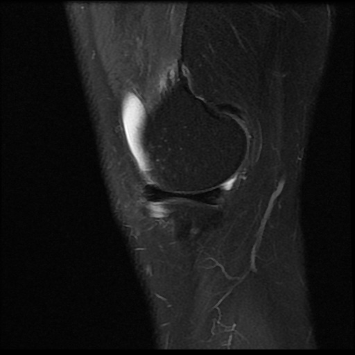 File:Anterior cruciate ligament avulsion fracture (Radiopaedia 58939-66193 Sagittal PD fat sat 18).jpg