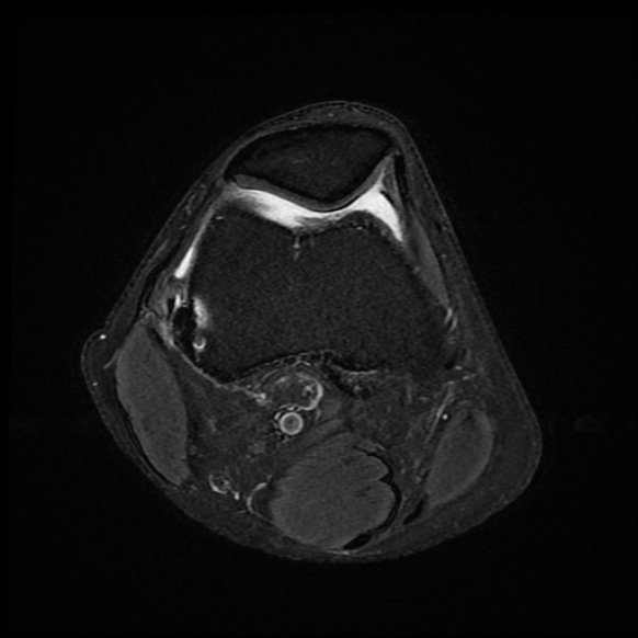 File:Anterior cruciate ligament graft tear and bucket-handle tear of medial meniscus (Radiopaedia 75867-87254 Axial PD fat sat 21).jpg