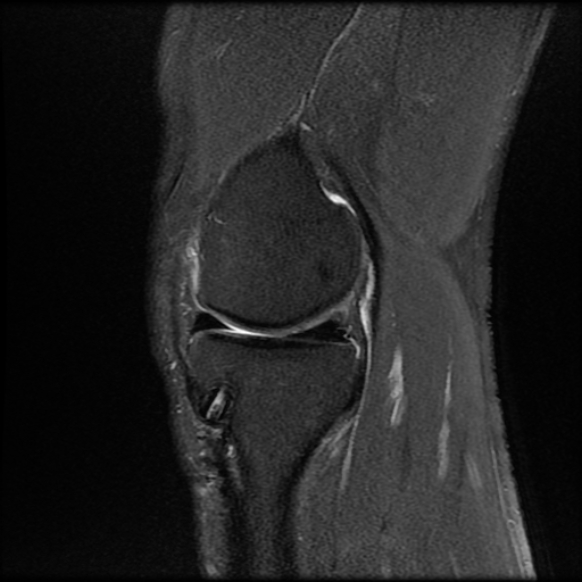 File:Anterior cruciate ligament graft tear and bucket-handle tear of medial meniscus (Radiopaedia 75867-87254 Sagittal PD fat sat 9).jpg