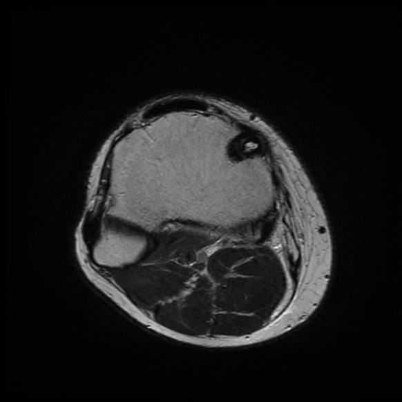 File:Anterior cruciate ligament graft tear and bucket-handle tear of medial meniscus (Radiopaedia 75867-87255 Axial T2 2).jpg