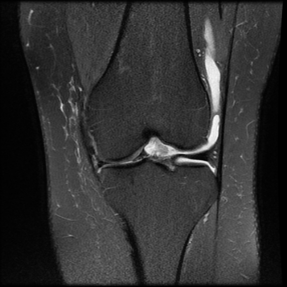File:Anterior cruciate ligament tear, Wrisberg rip and bucket-handle tear of medial meniscus (Radiopaedia 75872-87266 Coronal PD fat sat 13).jpg
