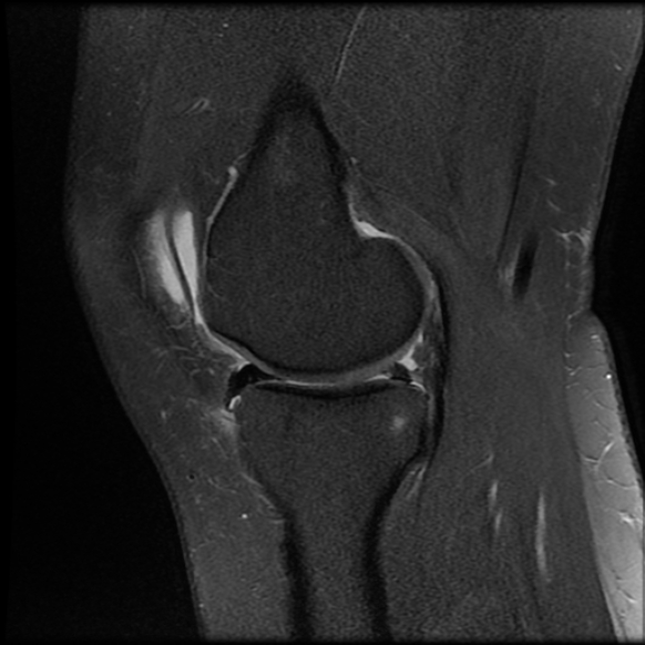 File:Anterior cruciate ligament tear, Wrisberg rip and bucket-handle tear of medial meniscus (Radiopaedia 75872-87266 Sagittal PD fat sat 18).jpg
