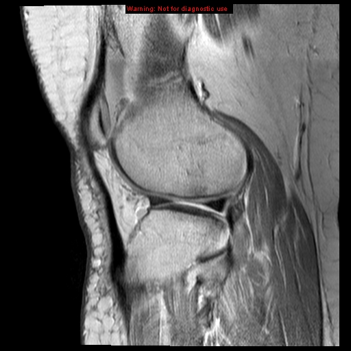 File:Anterior cruciate ligament tear (Radiopaedia 12329-12612 Sagittal T2 fat sat 5).jpg