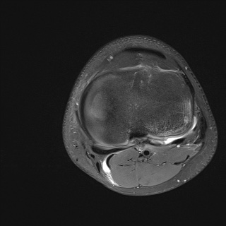 File:Anterior cruciate ligament tear - pediatric (Radiopaedia 62152-70260 Axial PD fat sat 27).jpg