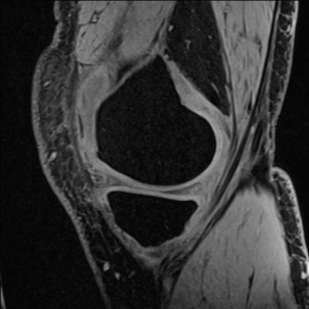 Anterior cruciate ligament tear - ramp lesion (Radiopaedia 71883-82322 Sagittal T1 vibe 106).jpg