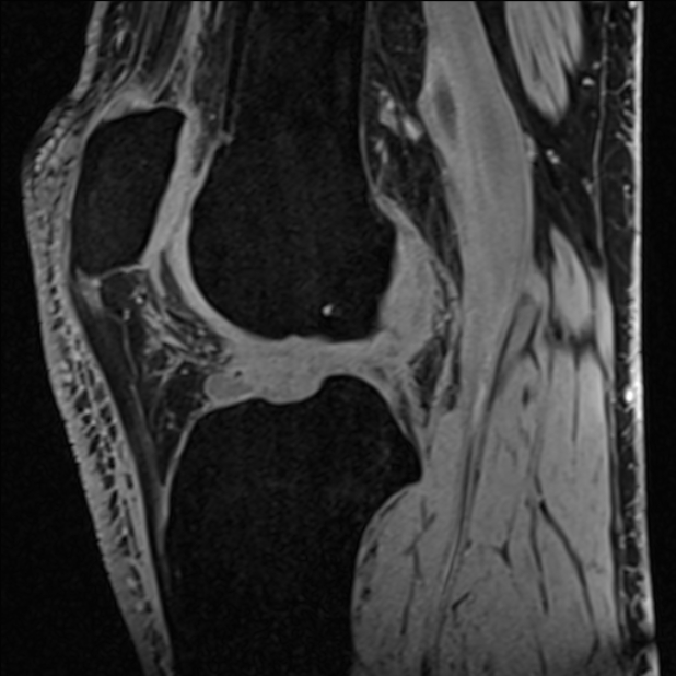 Anterior cruciate ligament tear - ramp lesion (Radiopaedia 71883-82322 Sagittal T1 vibe 65).jpg