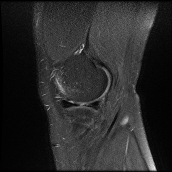 File:Anterior cruciate ligament tear with posteromedial corner injury, bucket-handle meniscal tear and chondral delamination (Radiopaedia 75501-86744 Sagittal PD fat sat 4).jpg