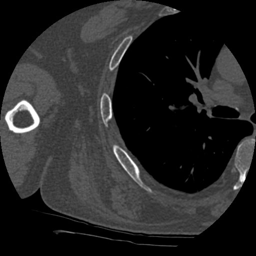 Anterior glenohumeral dislocation with Hill-Sachs lesion (Radiopaedia 62877-71249 Axial bone window 86).jpg