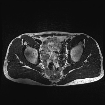 File:Anterior inferior iliac spine avulsion fracture (Radiopaedia 81312-95000 Axial T2 22).jpg